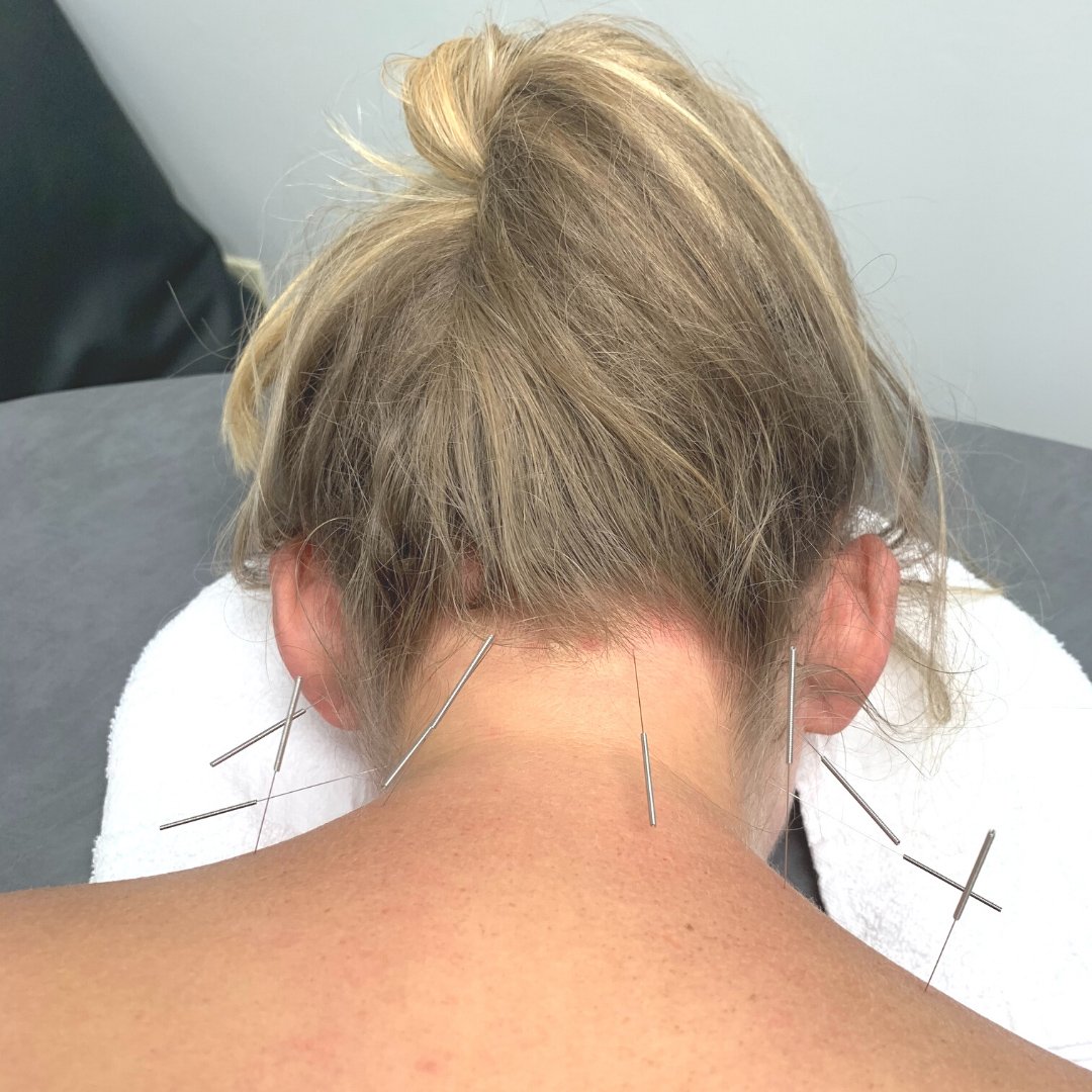 dry-needling-therapy-dunwoody-ga
