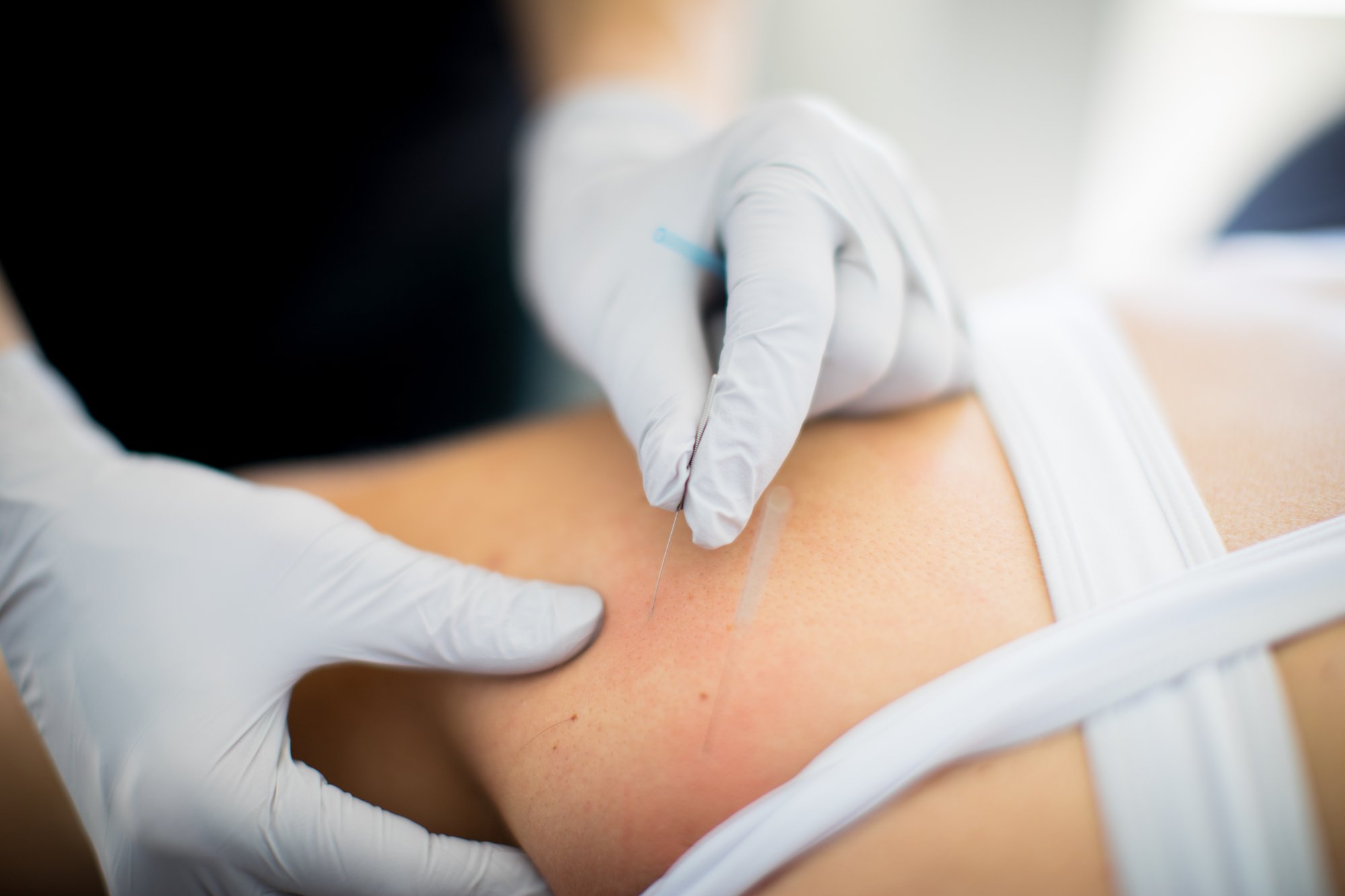 dry-needling-therapy-dunwoody-ga