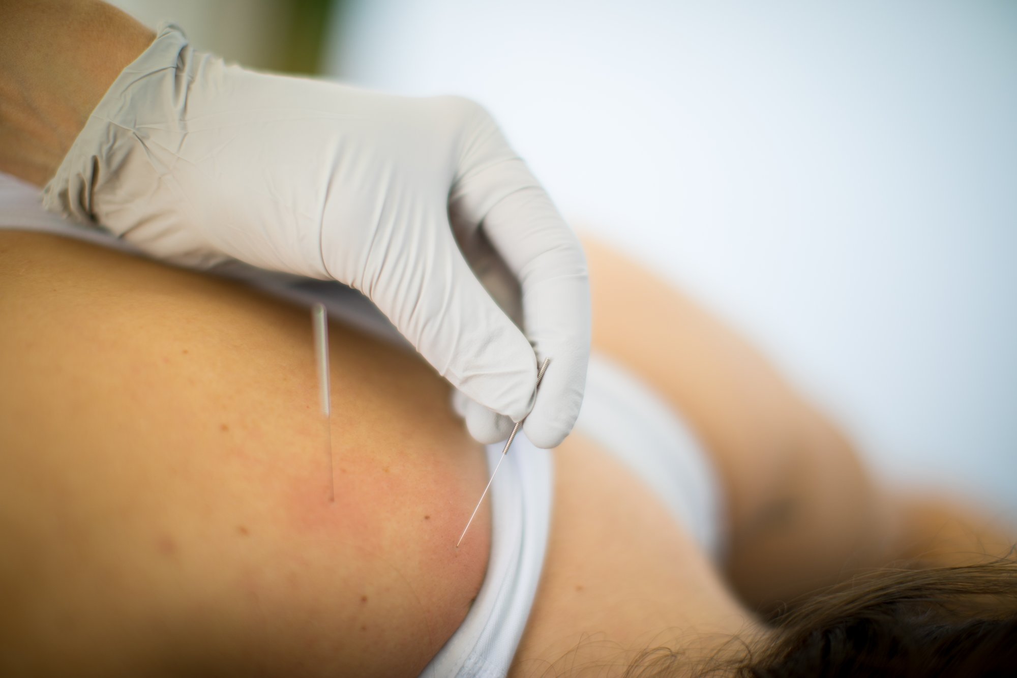 dry-needling-therapy-dunwoody-ga